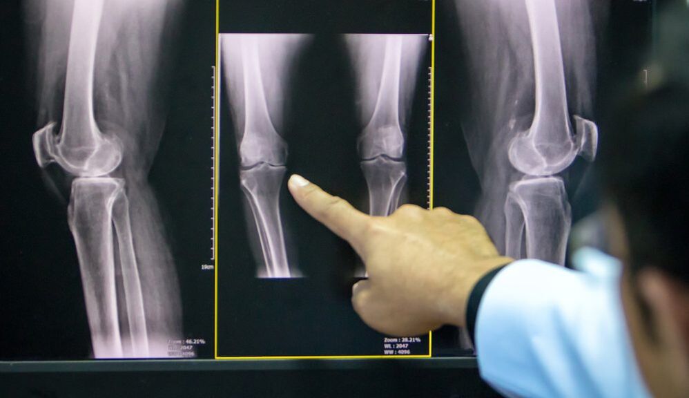 αρθρώσεις ακτινογραφίας γόνατος