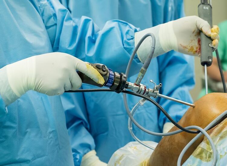 Αρθροσκόπηση - χειρουργική επέμβαση για οστεοαρθρίτιδα της άρθρωσης του γόνατος