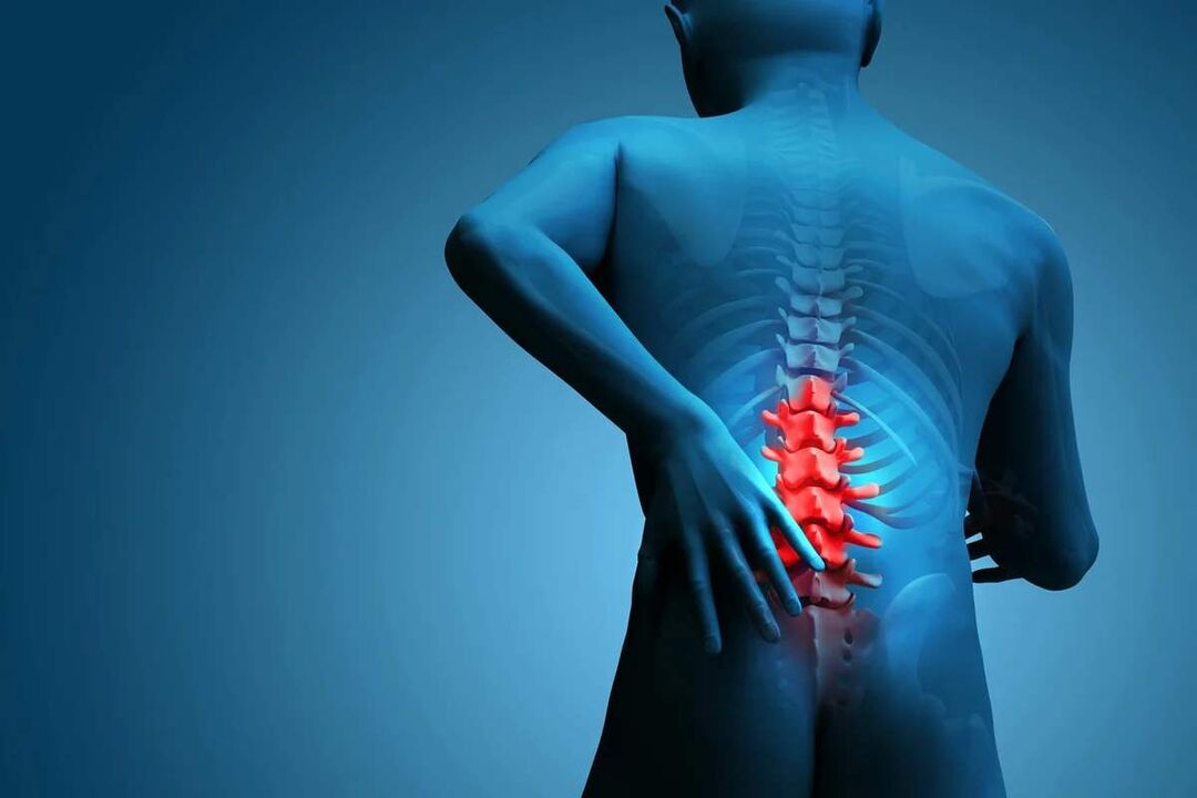Το κύριο σύμπτωμα της οστεοχόνδρωσης της οσφυϊκής μοίρας της σπονδυλικής στήλης είναι ο πόνος στη μέση. 