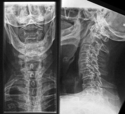Αυχενικός x -ray - Μέθοδος διάγνωσης της οστεοχονδρισμού