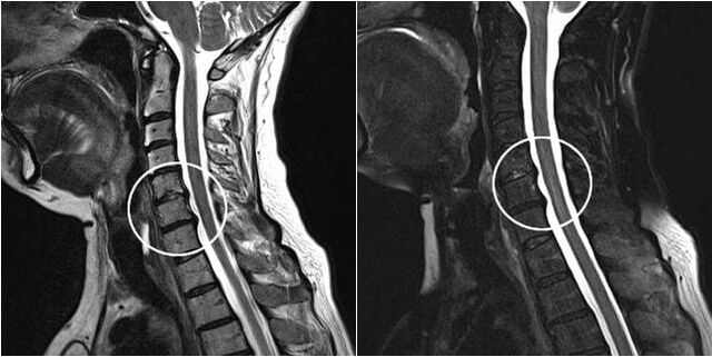 MRI της αυχενικής μοίρας της σπονδυλικής στήλης